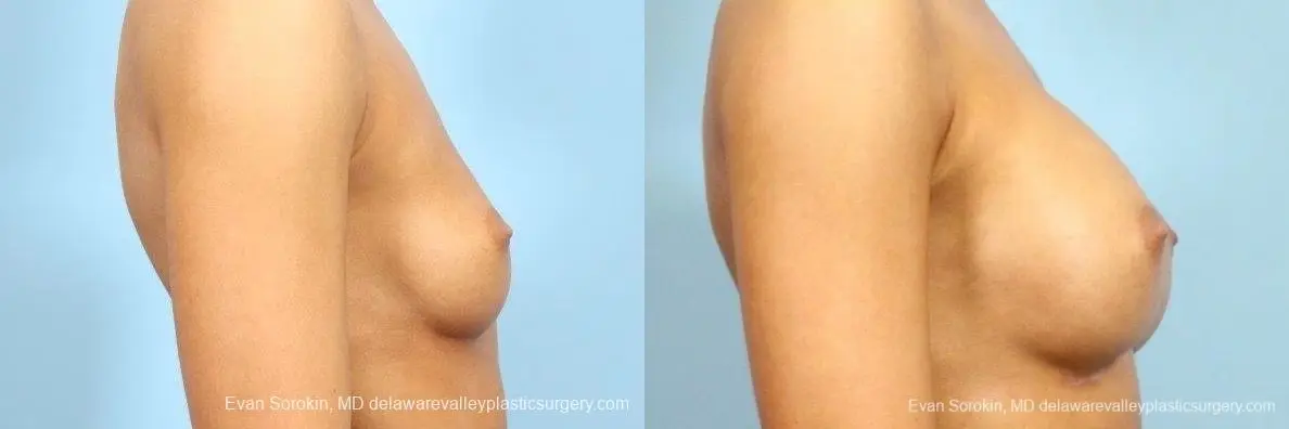 Philadelphia Breast Augmentation 8769 - Before and After 4