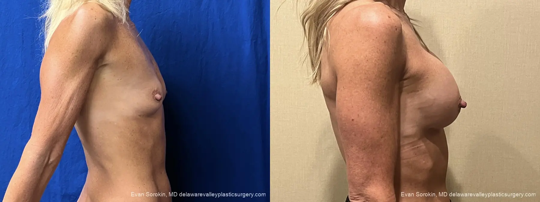 Breast Augmentation: Patient 319 - Before and After 3