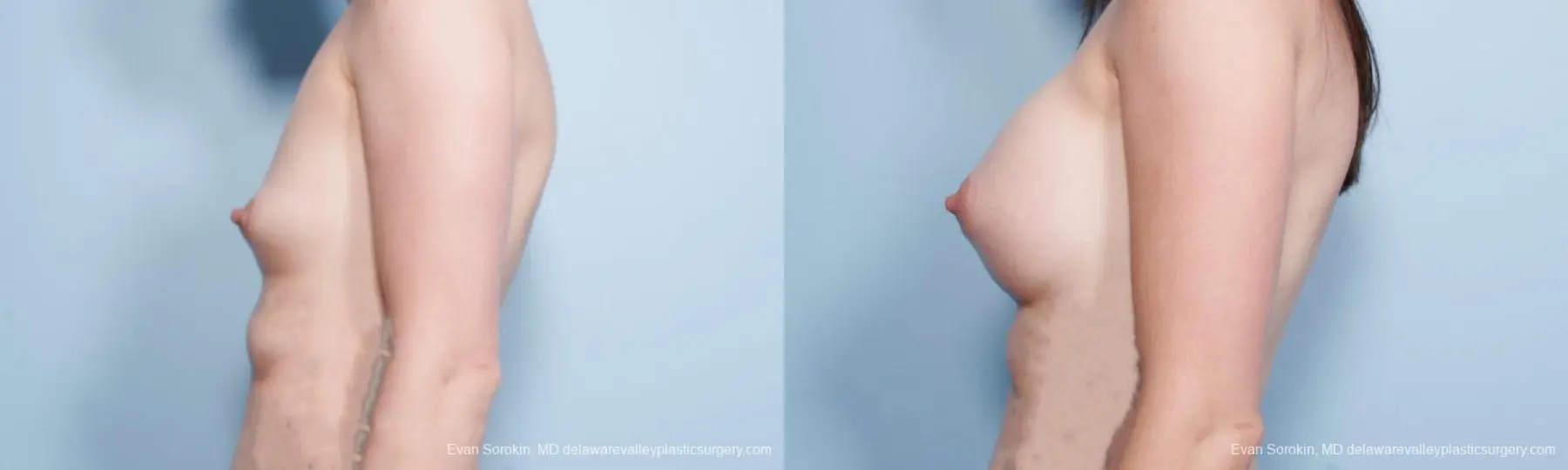 Philadelphia Breast Augmentation 9175 - Before and After 5