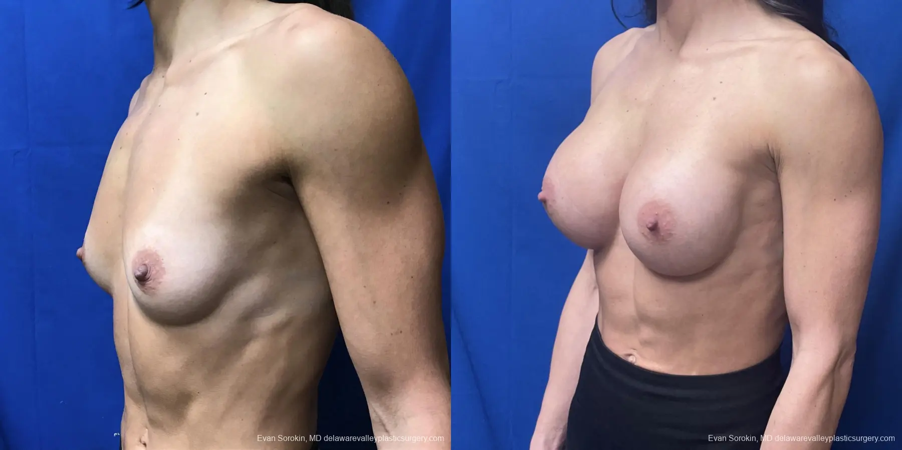 Breast Augmentation: Patient 189 - Before and After 4