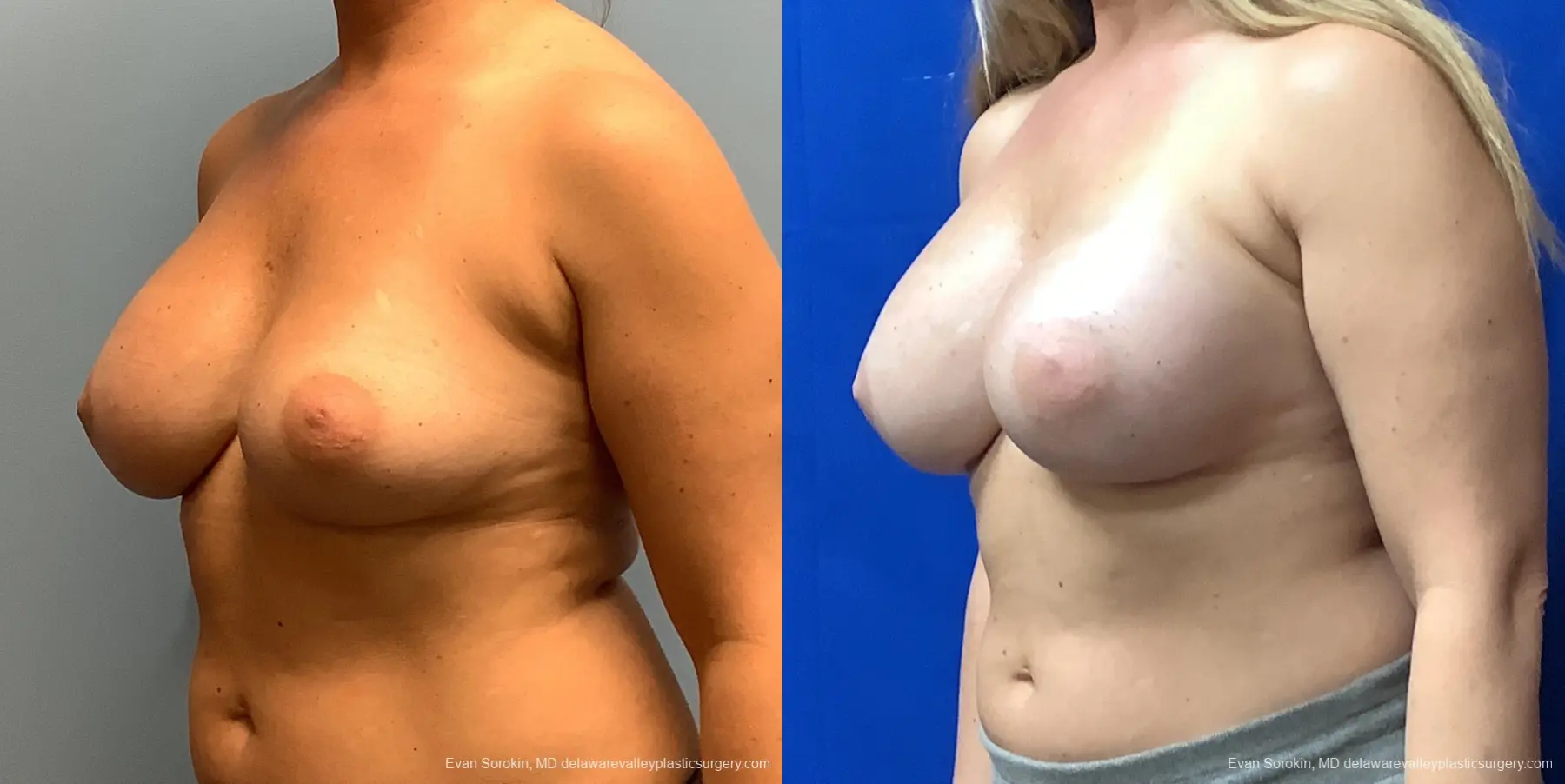 Breast Augmentation: Patient 225 - Before and After 2