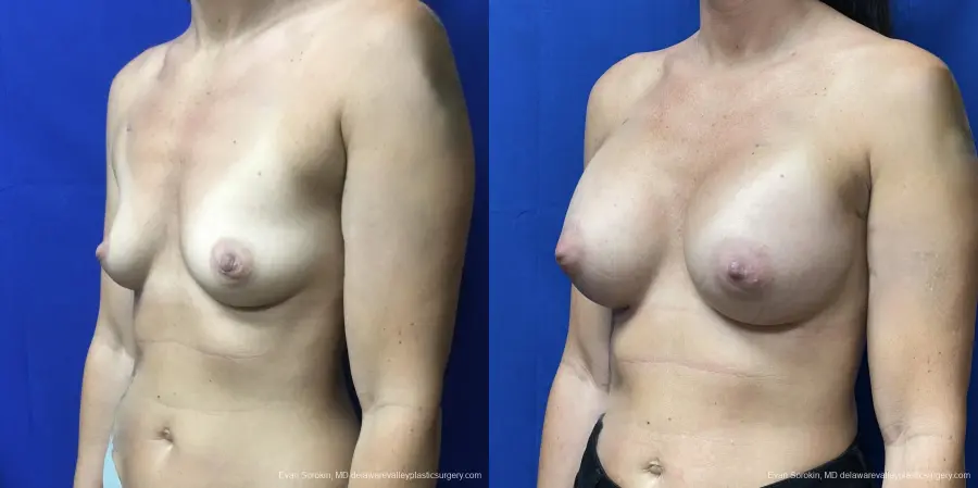 Breast Augmentation: Patient 202 - Before and After 2