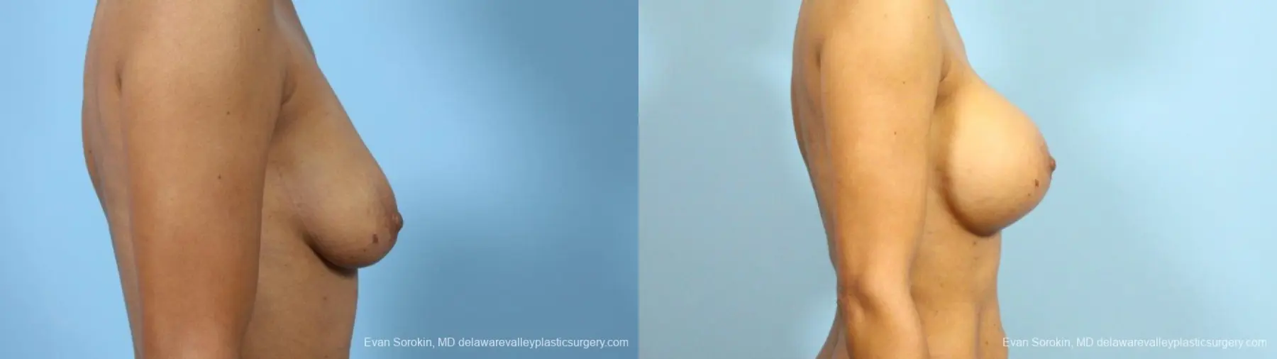 Philadelphia Breast Augmentation 9288 - Before and After 3
