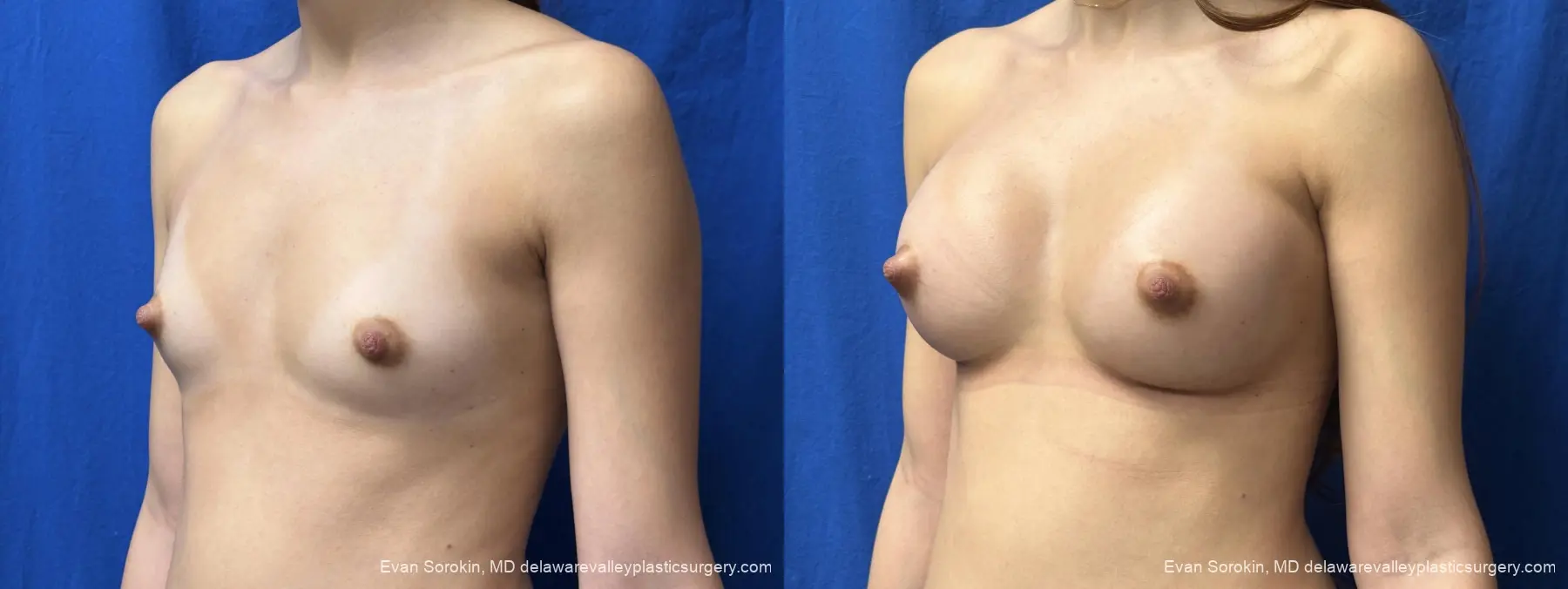Breast Augmentation: Patient 2 - Before and After 4