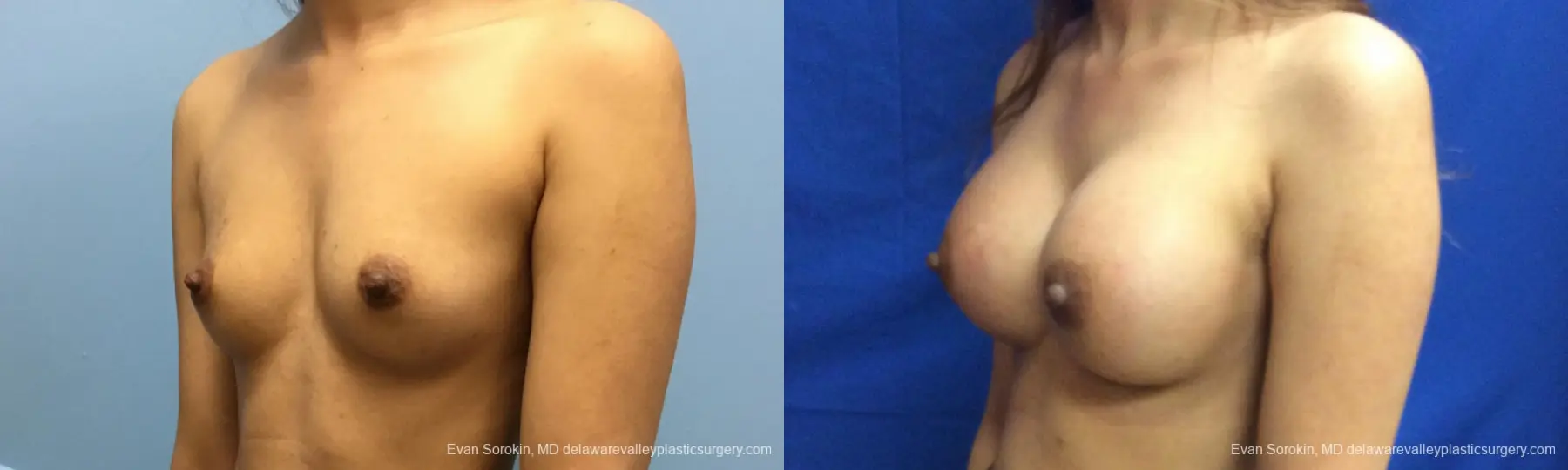 Philadelphia Breast Augmentation 12515 - Before and After 3