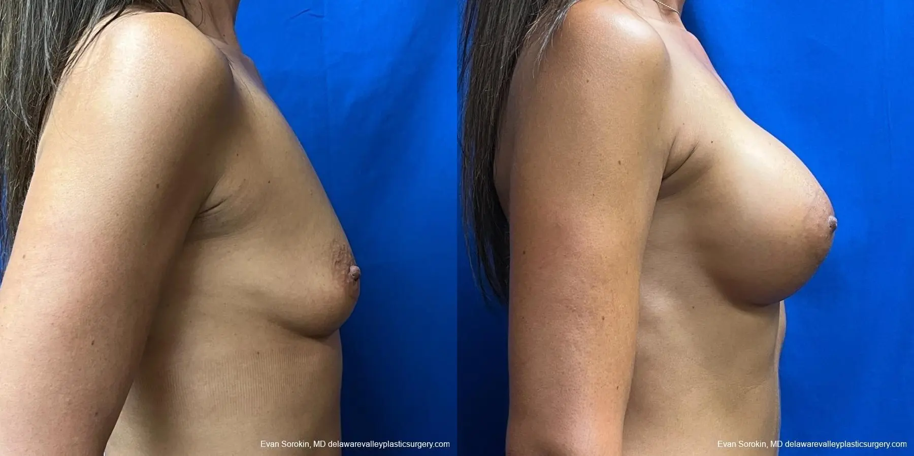 Breast Augmentation: Patient 236 - Before and After 3