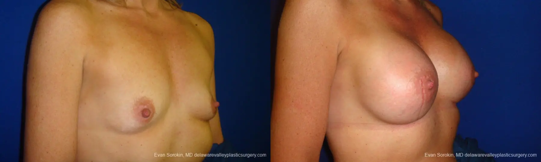 Philadelphia Breast Augmentation 9412 - Before and After 2