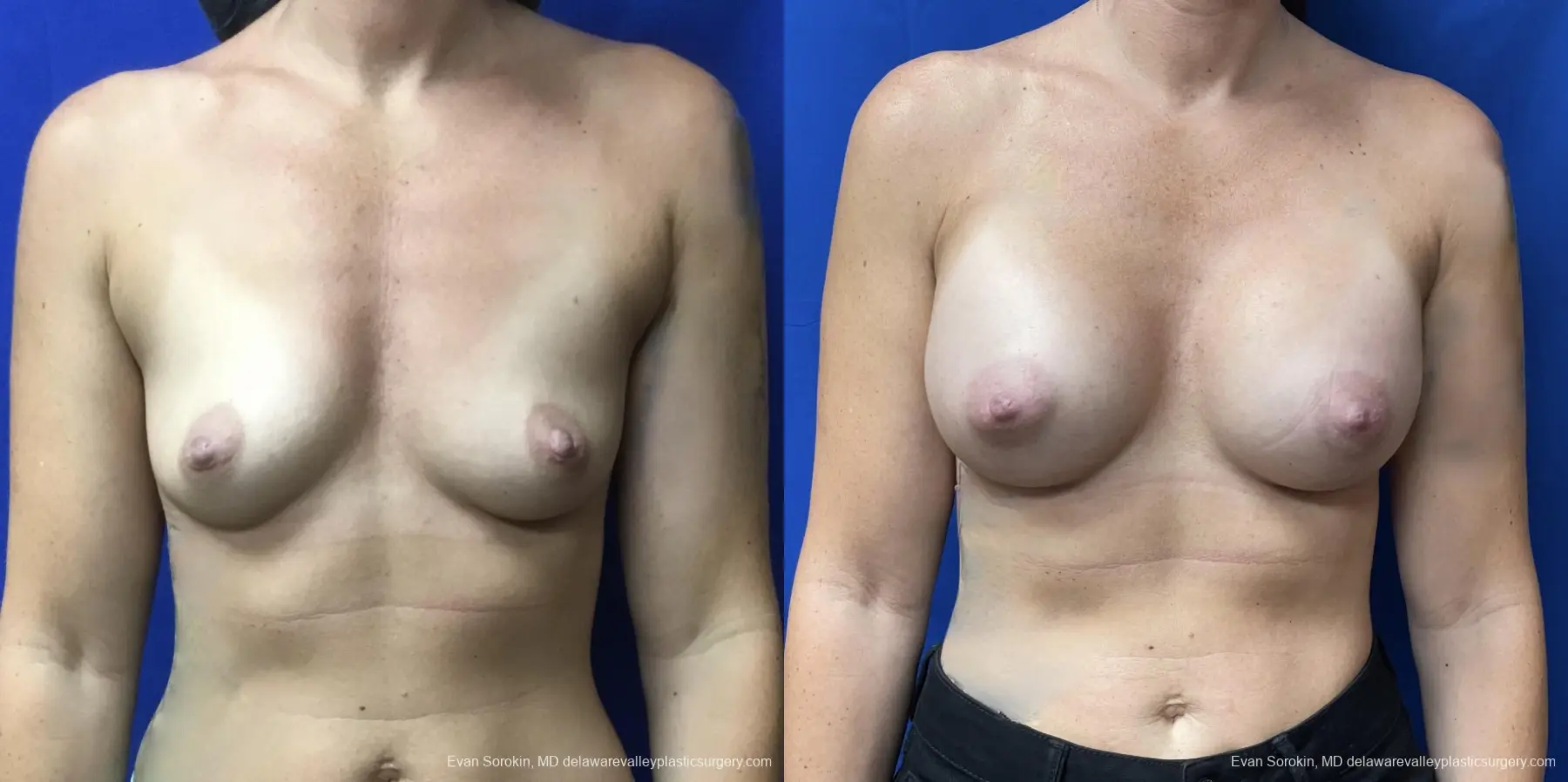 Breast Augmentation: Patient 175 - Before and After 1