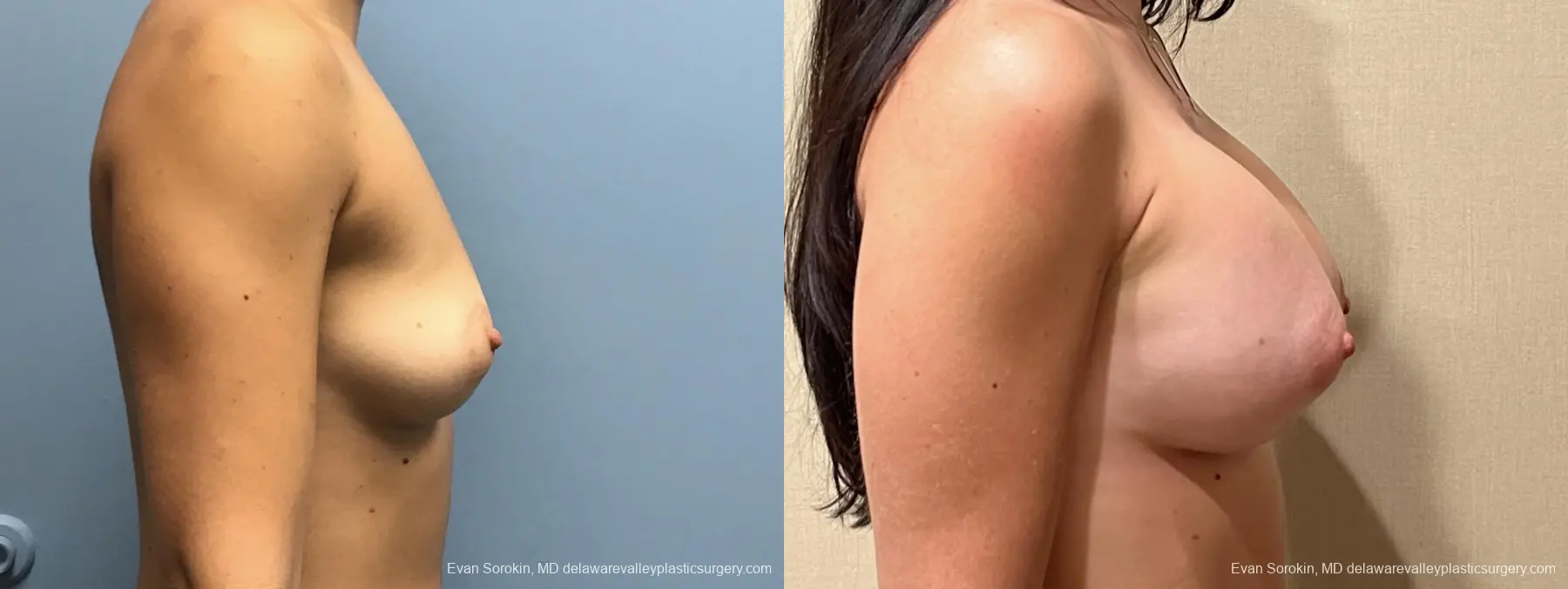 Breast Augmentation: Patient 204 - Before and After 3
