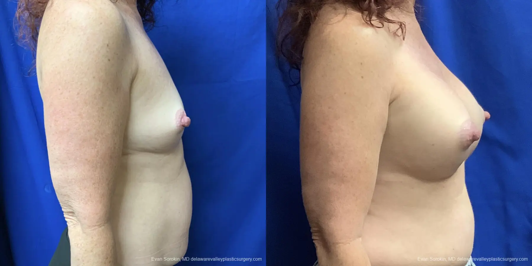 Breast Augmentation: Patient 176 - Before and After 3