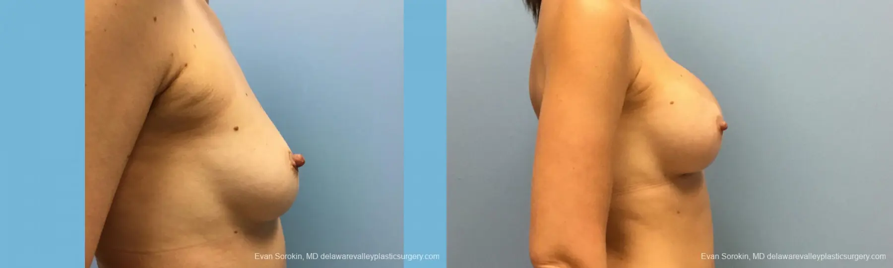 Philadelphia Breast Augmentation 12514 - Before and After 4