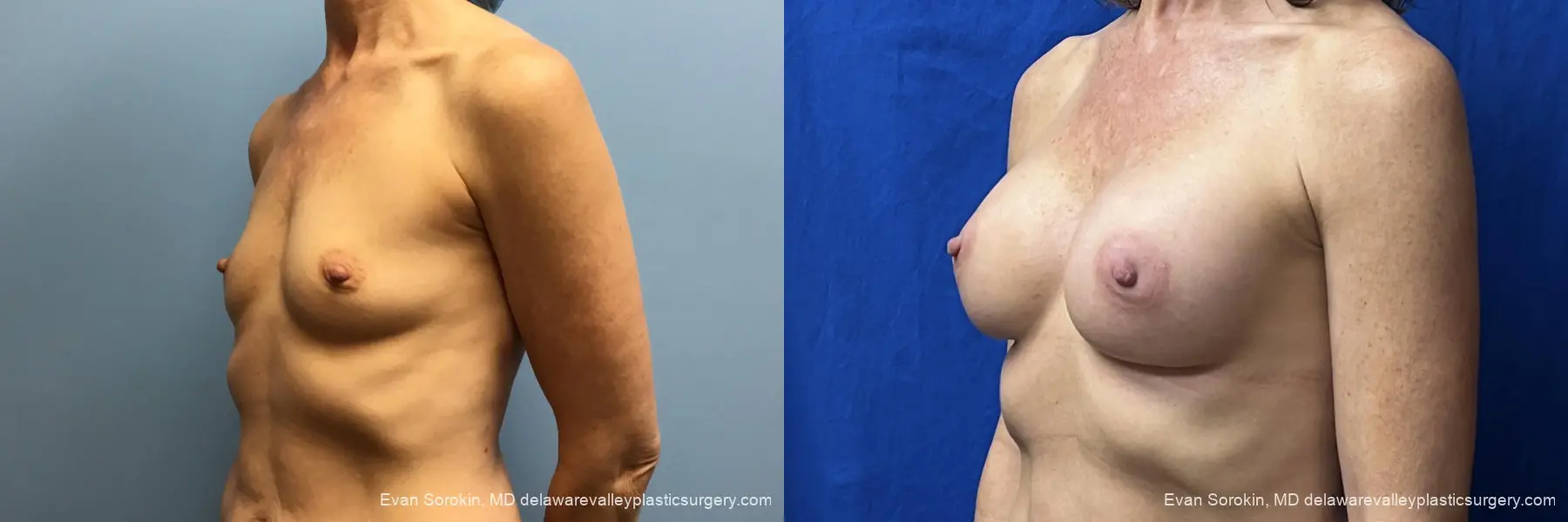 Breast Augmentation: Patient 6 - Before and After 4