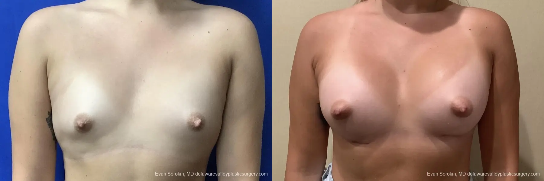 Breast Augmentation: Patient 198 - Before and After 1