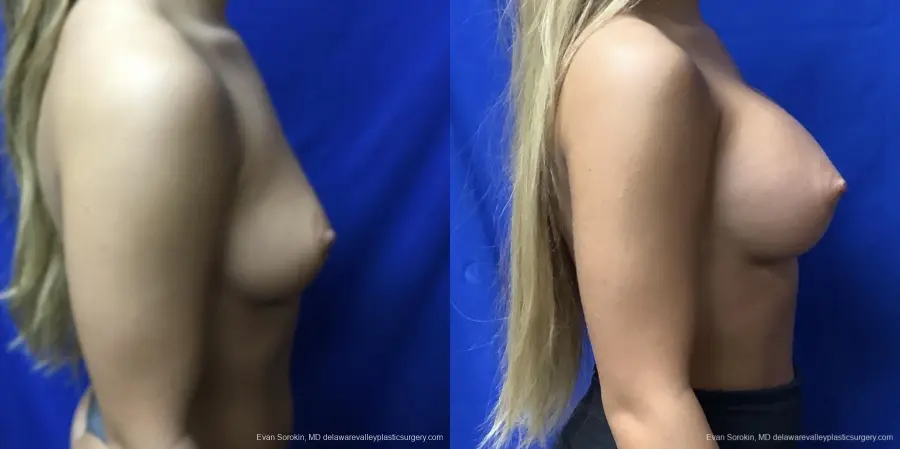 Breast Augmentation: Patient 167 - Before and After 3