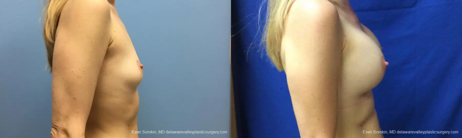Philadelphia Breast Augmentation 12520 - Before and After 4