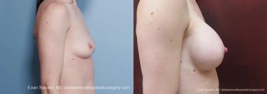 Philadelphia Breast Augmentation 9107 - Before and After 3