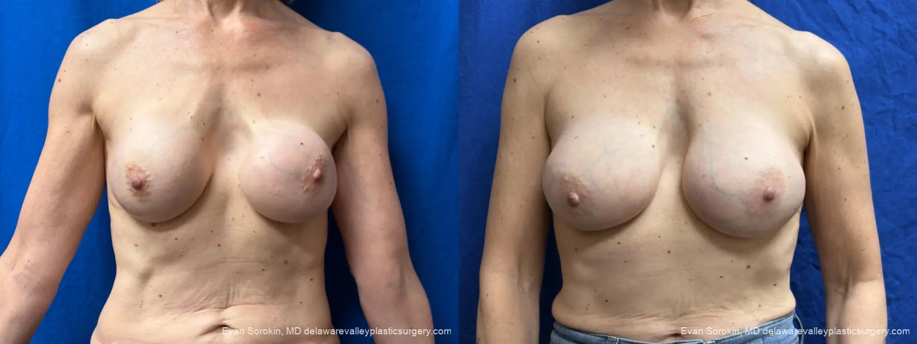 Breast Augmentation Revision: Patient 51 - Before and After 1