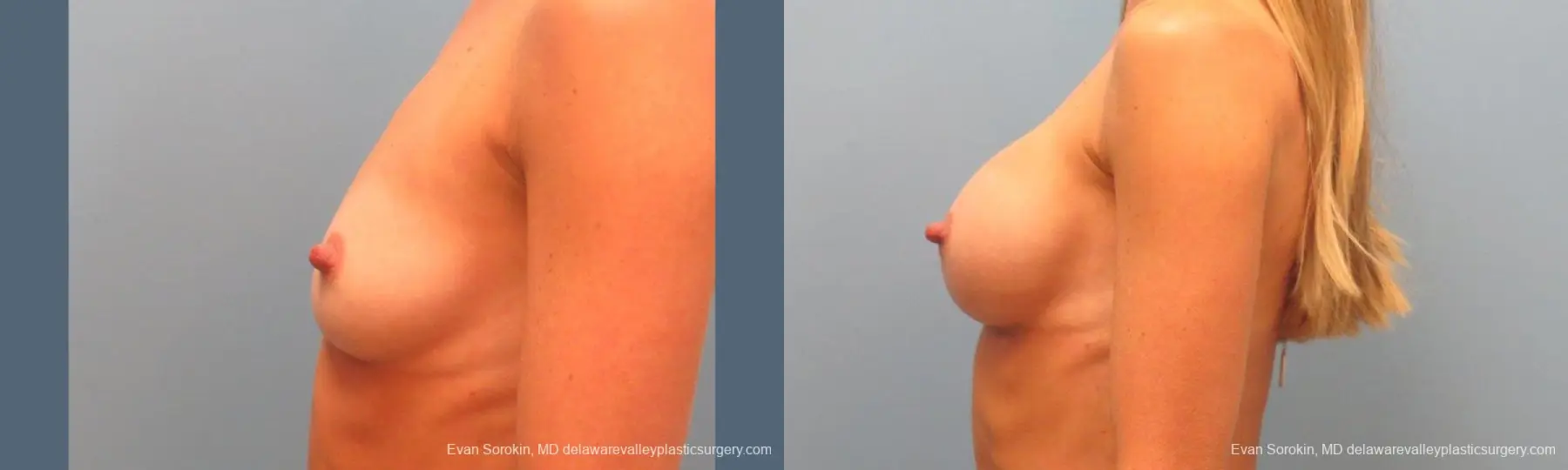 Philadelphia Breast Augmentation 9396 - Before and After 5