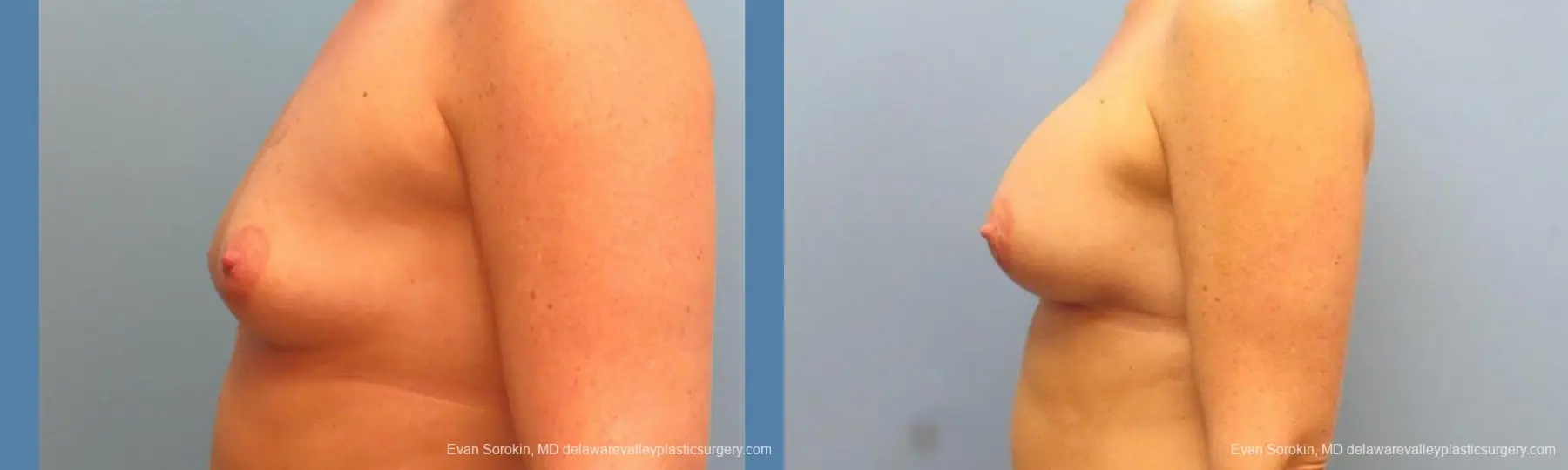 Philadelphia Breast Augmentation 9487 - Before and After 5