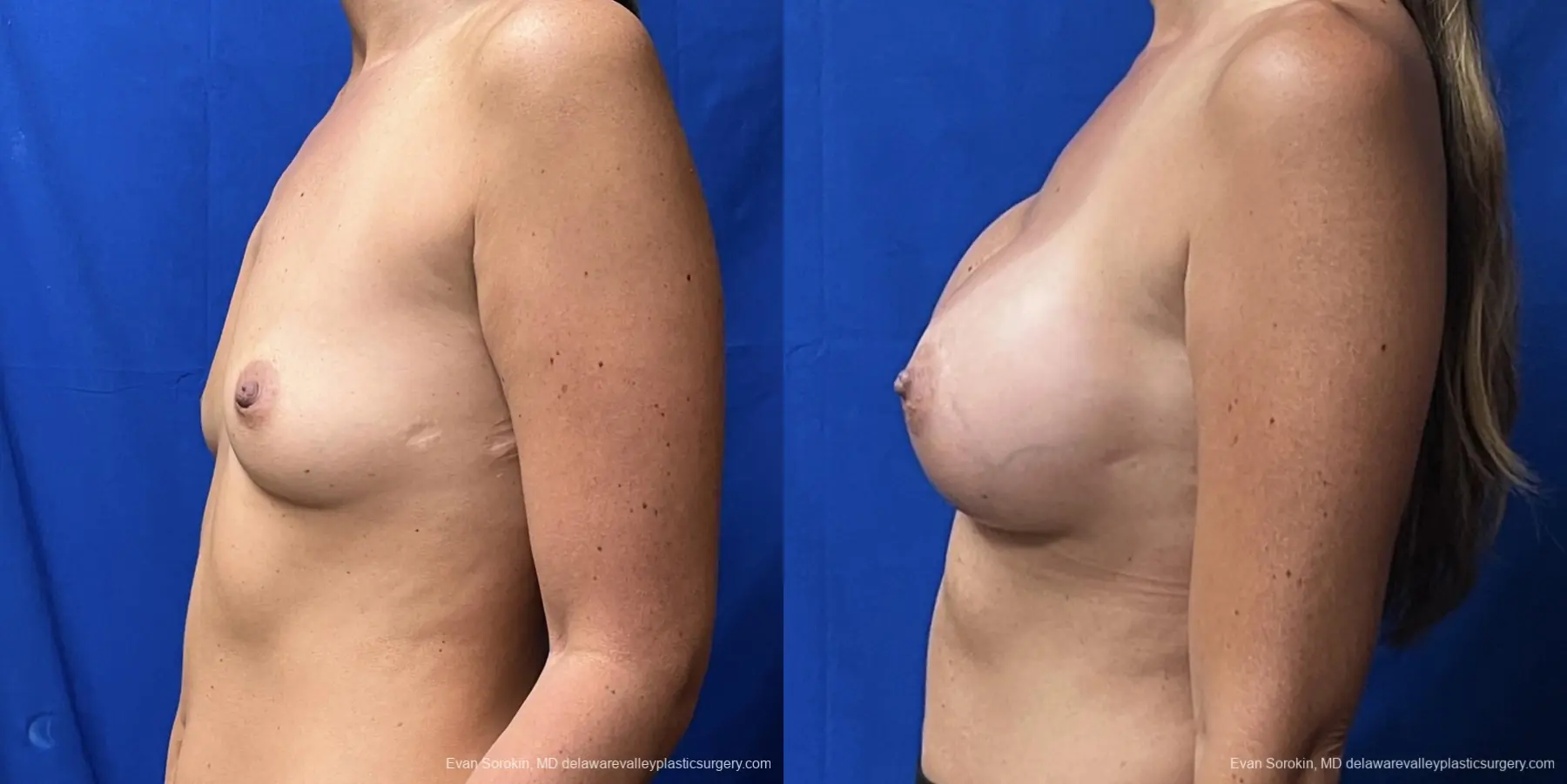 Breast Augmentation: Patient 230 - Before and After 5
