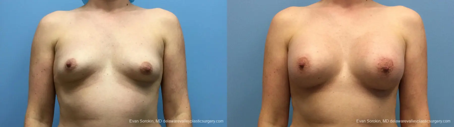 Philadelphia Breast Augmentation 13181 - Before and After 1