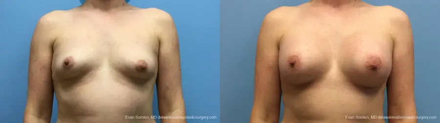 Philadelphia Breast Augmentation 13181 - Before and After 1