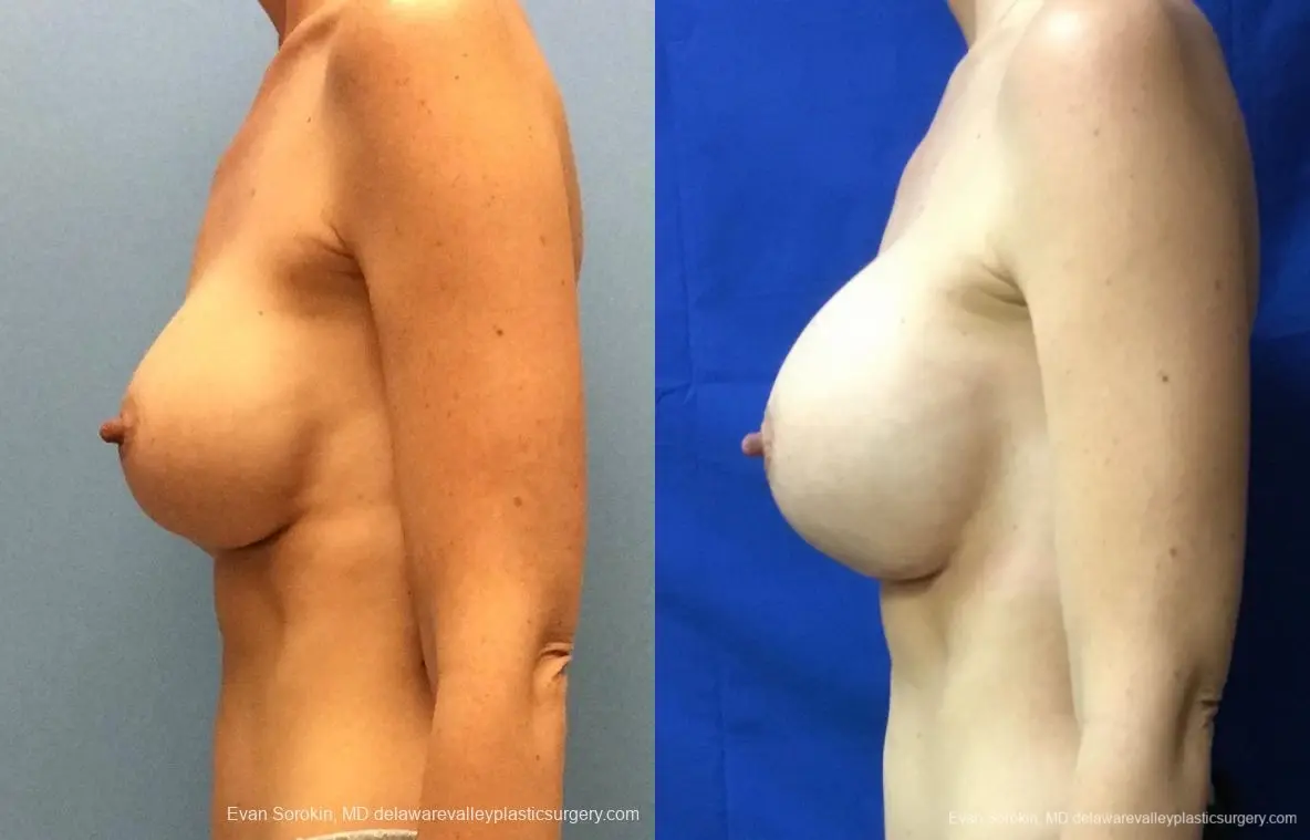 Philadelphia Breast Augmentation 13069 - Before and After 5