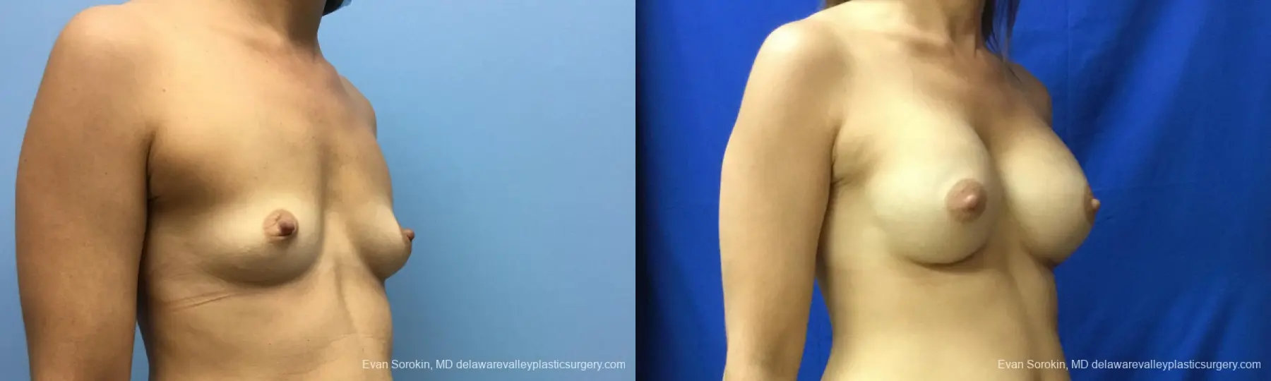 Philadelphia Breast Augmentation 12519 - Before and After 2