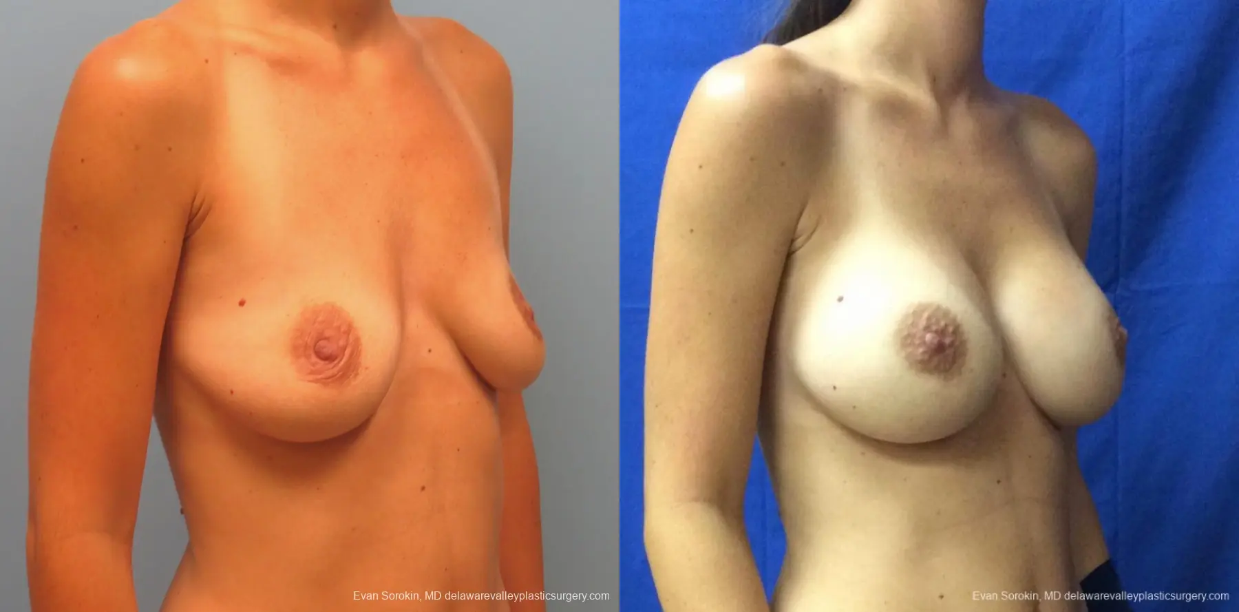 Philadelphia Breast Augmentation 13067 - Before and After 2
