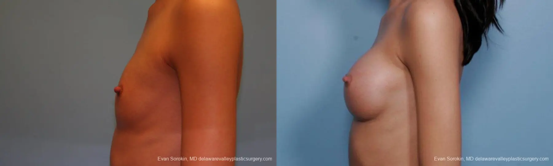 Philadelphia Breast Augmentation 9377 - Before and After 5