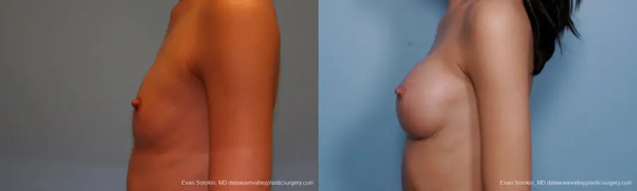 Philadelphia Breast Augmentation 9377 - Before and After 5