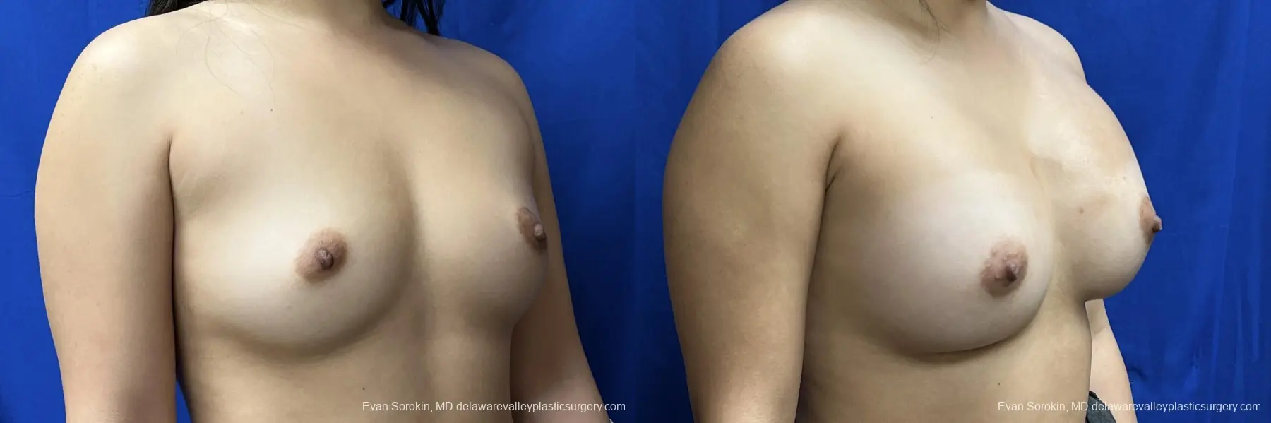 Breast Augmentation: Patient 210 - Before and After 2