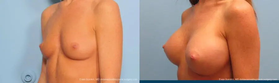 Philadelphia Breast Augmentation 9179 - Before and After 4