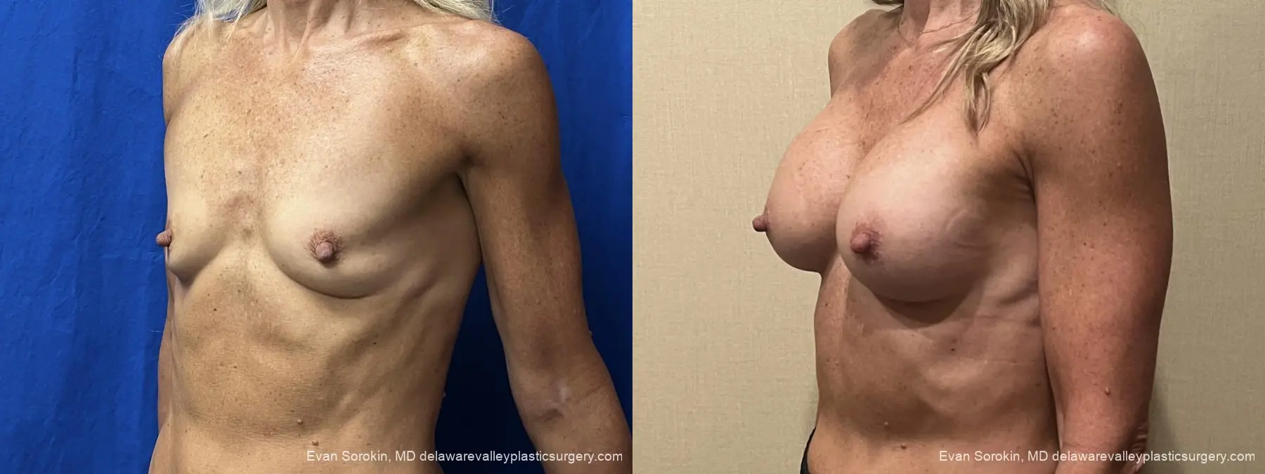 Breast Augmentation: Patient 319 - Before and After 4
