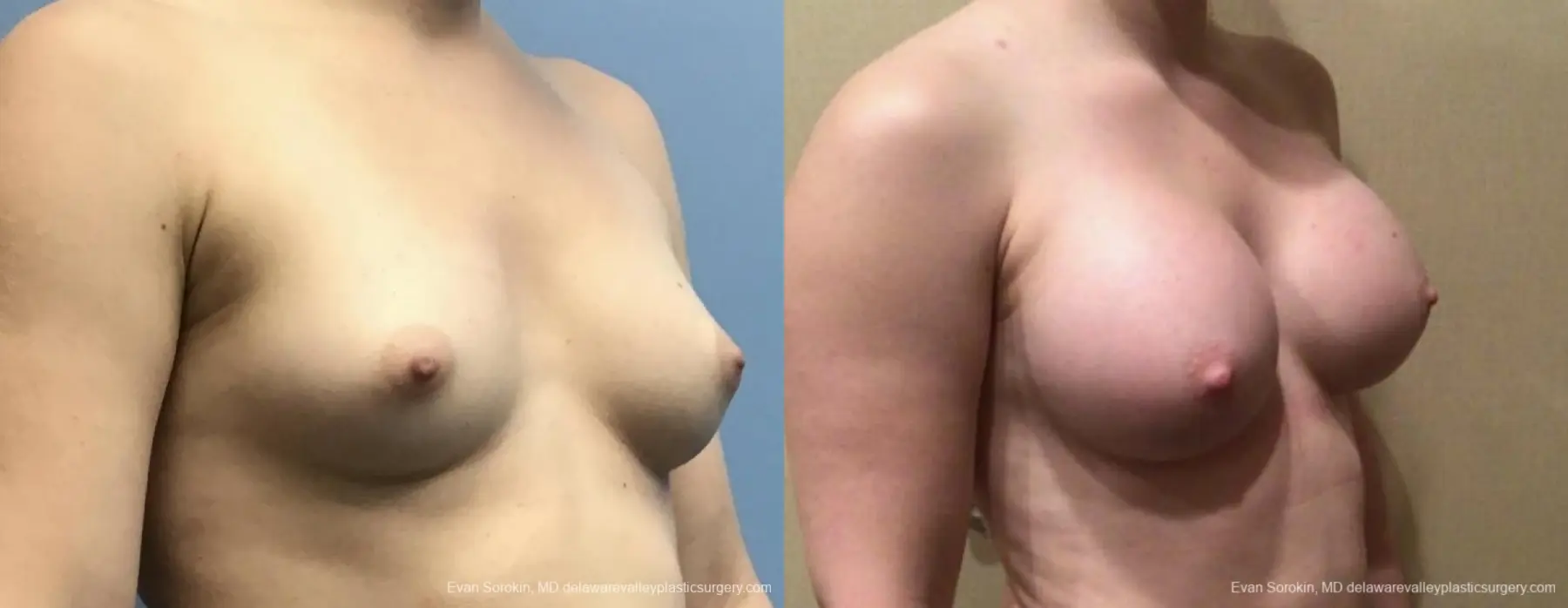 Breast Augmentation: Patient 193 - Before and After 2