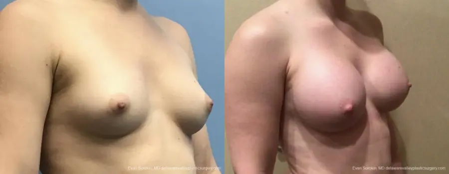 Breast Augmentation: Patient 164 - Before and After 2