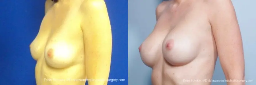 Philadelphia Breast Augmentation 8776 - Before and After 3