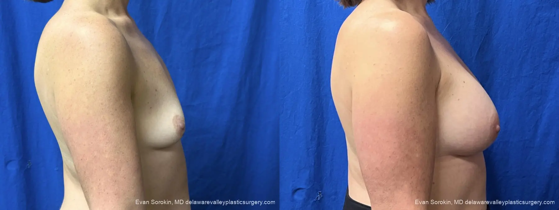 Breast Augmentation: Patient 337 - Before and After 3