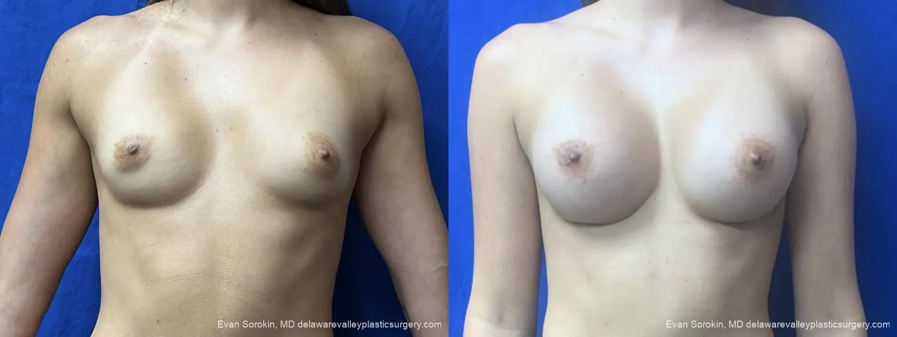 Breast Augmentation: Patient 5 - Before and After