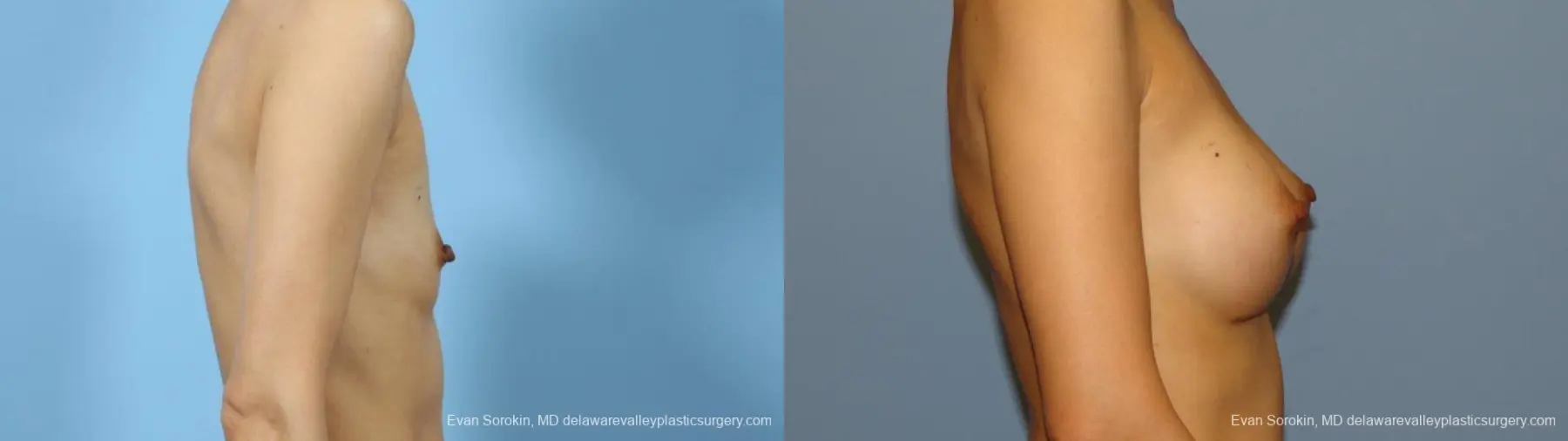 Philadelphia Breast Augmentation 9291 - Before and After 3