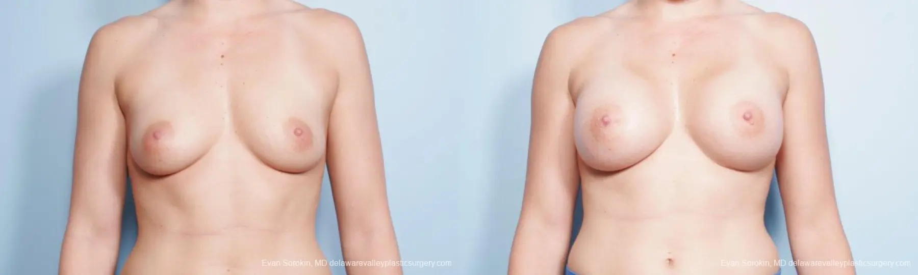 Philadelphia Breast Augmentation 9296 - Before and After 1
