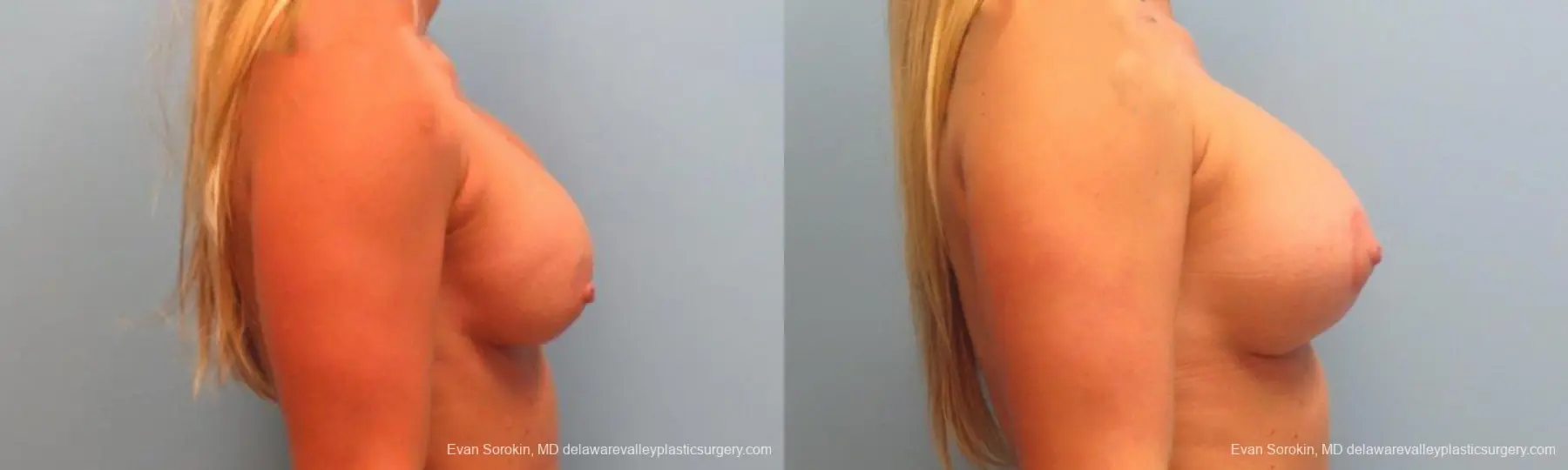 Philadelphia Breast Augmentation 9369 - Before and After 5