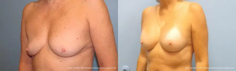Philadelphia Breast Augmentation 9600 - Before and After 4
