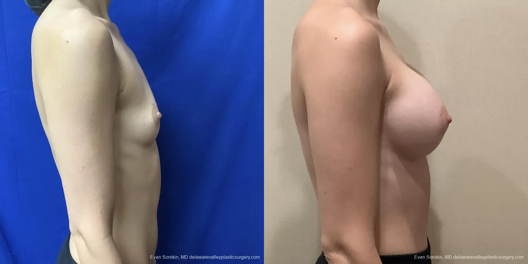 Breast Augmentation: Patient 210 - Before and After 3