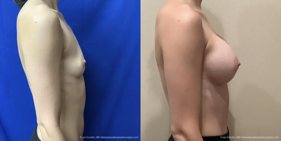 Breast Augmentation: Patient 181 - Before and After 3