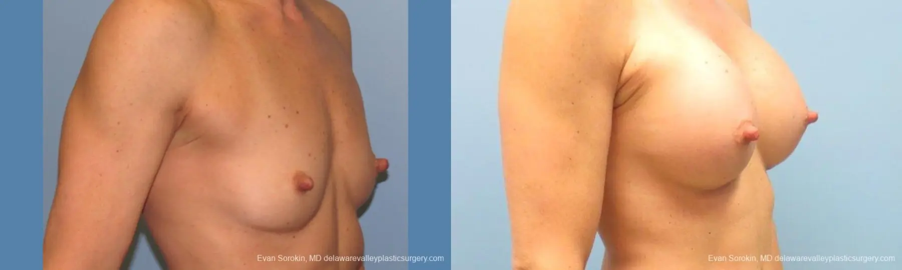 Philadelphia Breast Augmentation 9744 - Before and After 2