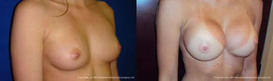 Philadelphia Breast Augmentation 9293 - Before and After 2