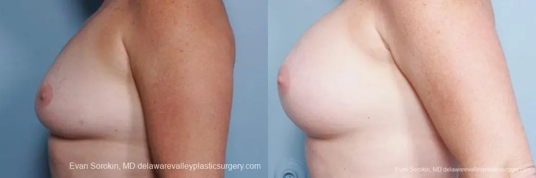 Philadelphia Breast Augmentation 9316 - Before and After 5