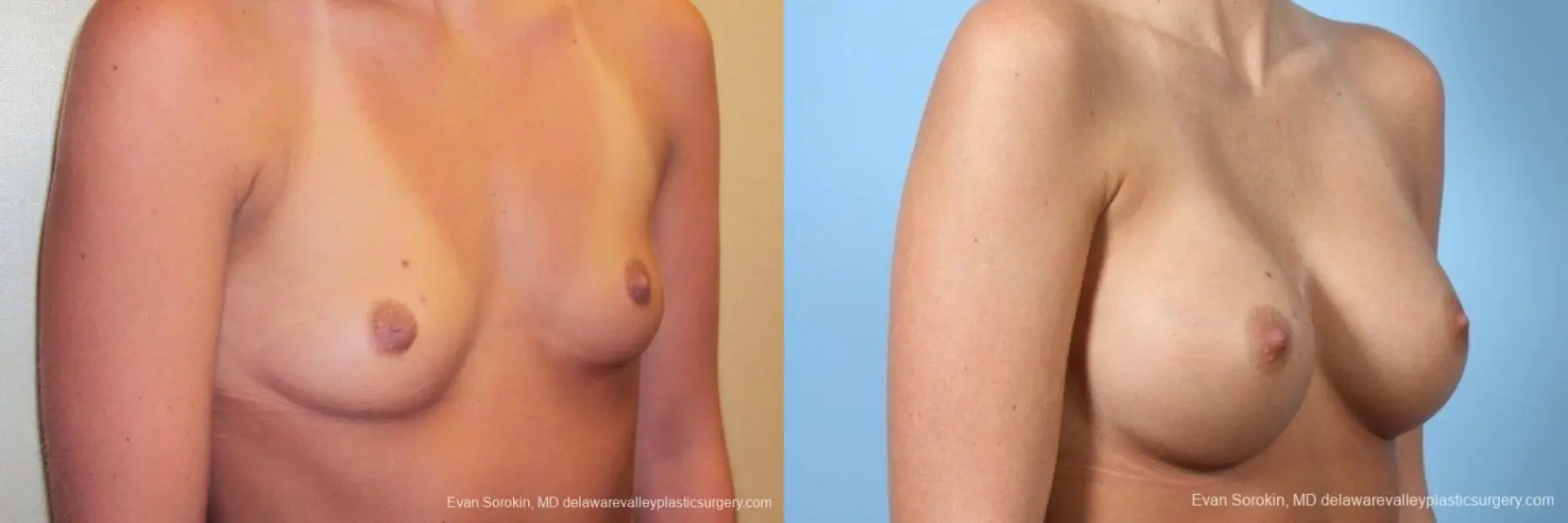 Philadelphia Breast Augmentation 8772 - Before and After 2