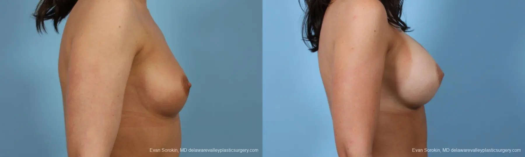 Philadelphia Breast Augmentation 8643 - Before and After 3